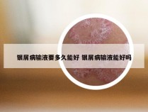 银屑病输液要多久能好 银屑病输液能好吗