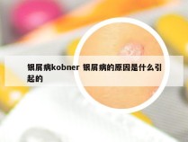 银屑病kobner 银屑病的原因是什么引起的