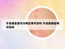 牛皮癣患者可以喝百事可乐吗 牛皮肤癣能喝可乐吗