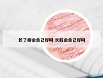 长了癣会自己好吗 长藓会自己好吗