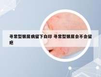 寻常型银屑病留下白印 寻常型银屑会不会留疤