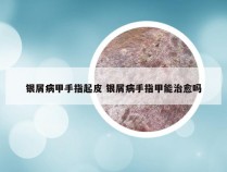 银屑病甲手指起皮 银屑病手指甲能治愈吗