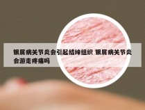 银屑病关节炎会引起结缔组织 银屑病关节炎会游走疼痛吗