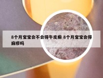 8个月宝宝会不会得牛皮癣 8个月宝宝会得麻疹吗