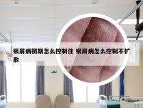 银屑病初期怎么控制住 银屑病怎么控制不扩散