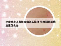 孕晚期身上有银屑病怎么处理 孕晚期银屑病加重怎么办