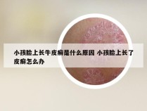 小孩脸上长牛皮癣是什么原因 小孩脸上长了皮癣怎么办
