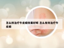 怎么样治疗牛皮癣效果好呢 怎么有效治疗牛皮癣