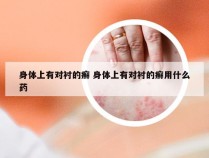 身体上有对衬的癣 身体上有对衬的癣用什么药