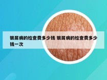 银屑病的检查费多少钱 银屑病的检查费多少钱一次