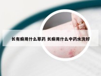 长有癣用什么草药 长癣用什么中药水洗好