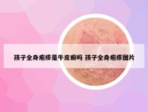 孩子全身疱疹是牛皮癣吗 孩子全身疱疹图片