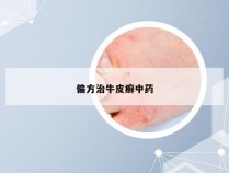 偏方治牛皮癣中药