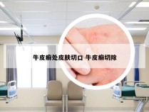 牛皮癣处皮肤切口 牛皮癣切除