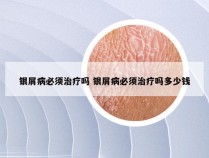 银屑病必须治疗吗 银屑病必须治疗吗多少钱
