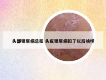 头部银屑病总扣 头皮银屑病扣了以后啥样