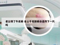 老公得了牛皮癣 老公牛皮肤癣会遗传下一代吗