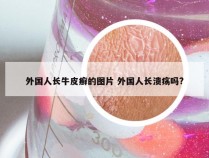 外国人长牛皮癣的图片 外国人长溃疡吗?