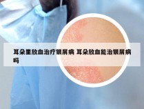 耳朵里放血治疗银屑病 耳朵放血能治银屑病吗