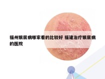 福州银屑病哪家看的比较好 福建治疗银屑病的医院