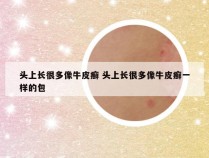 头上长很多像牛皮癣 头上长很多像牛皮癣一样的包