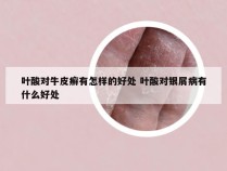 叶酸对牛皮癣有怎样的好处 叶酸对银屑病有什么好处