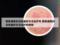 银屑病真的没有最好方法治疗吗 银屑病真的没有最好方法治疗吗视频