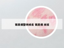 银屑病整块掉皮 银屑病 掉皮
