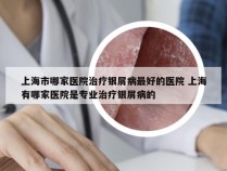 上海市哪家医院治疗银屑病最好的医院 上海有哪家医院是专业治疗银屑病的