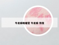牛皮癣晚睡觉 牛皮癣 熬夜