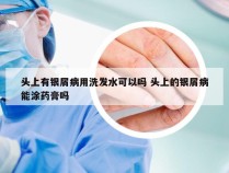 头上有银屑病用洗发水可以吗 头上的银屑病能涂药膏吗