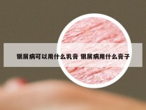 银屑病可以用什么乳膏 银屑病用什么膏子