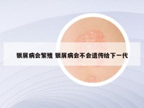 银屑病会繁殖 银屑病会不会遗传给下一代
