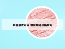 银屑病皮可以 银屑病可以换皮吗