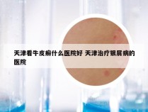 天津看牛皮癣什么医院好 天津治疗银屑病的医院