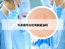 牛皮癣可以吃鸡精酱油吗
