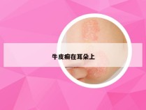 牛皮癣在耳朵上