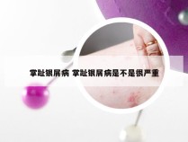 掌趾银屑病 掌趾银屑病是不是很严重