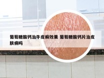 葡萄糖酸钙治牛皮癣效果 葡萄糖酸钙片治皮肤病吗