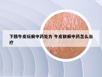 下肢牛皮玩癣中药处方 牛皮肤癣中药怎么治疗
