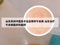 山东民间中医高手治淄博市牛皮癣 山东治疗牛皮癣最好的医院