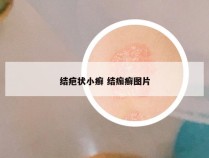 结疤状小癣 结痂癣图片
