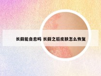 长藓能自愈吗 长藓之后皮肤怎么恢复