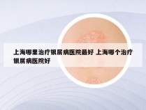 上海哪里治疗银屑病医院最好 上海哪个治疗银屑病医院好