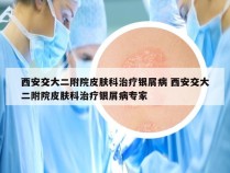 西安交大二附院皮肤科治疗银屑病 西安交大二附院皮肤科治疗银屑病专家