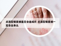 点滴型银屑病是否会连成片 点滴型银屑病一定会全身么