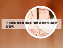 牛皮癣吃裙带菜可以吗 银屑病患者可以吃裙带菜吗