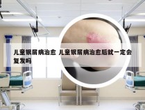 儿童银屑病治愈 儿童银屑病治愈后就一定会复发吗