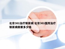 北京301治疗银屑病 北京301医院治疗银屑病需要多少钱