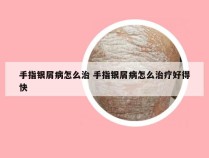 手指银屑病怎么治 手指银屑病怎么治疗好得快